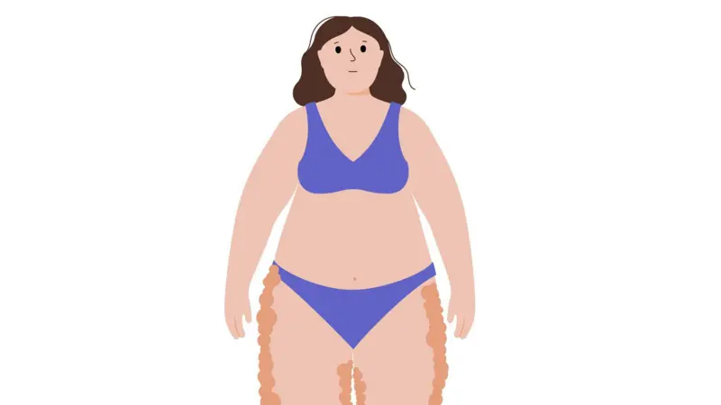 el lipedema