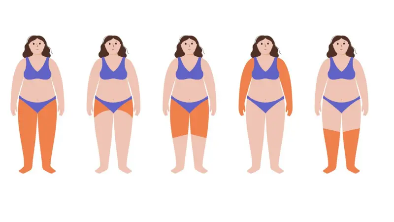 el lipedema