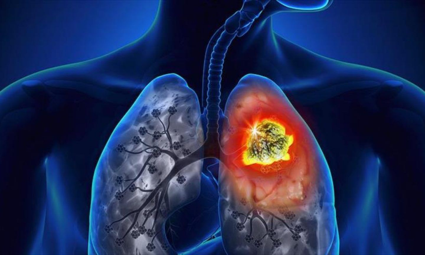 cáncer de pulmón enfermedades vacunas Europa