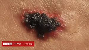 Cáncer de piel: el tratamiento que permite que 52% de pacientes sobreviva 5 años más
