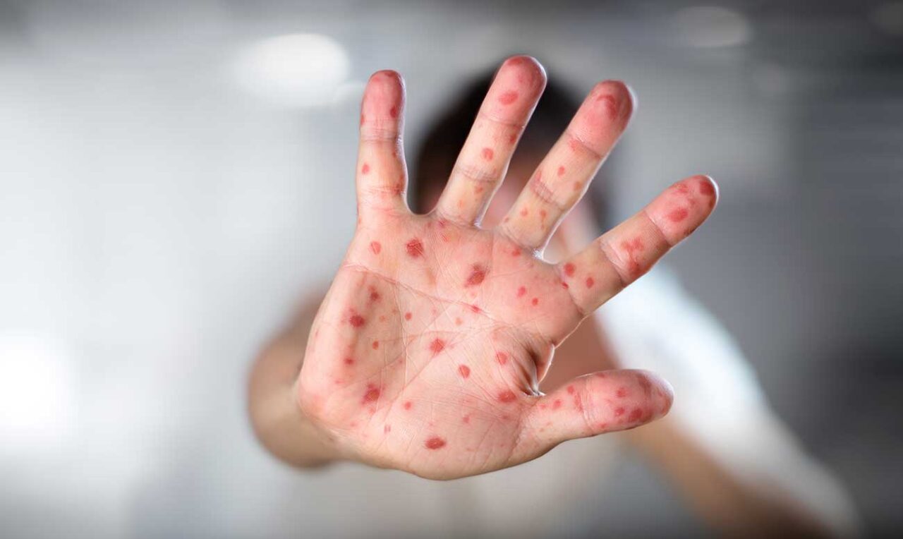 El Sarampión, un virus que causó alarma en Disneylandia