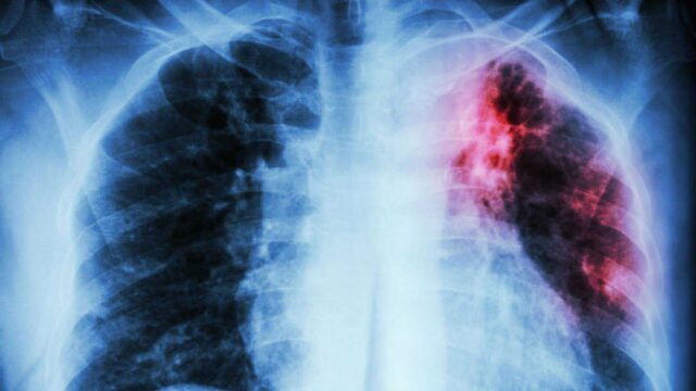 La tuberculosis vuelve a propagarse en el mundo, advierte la OMS