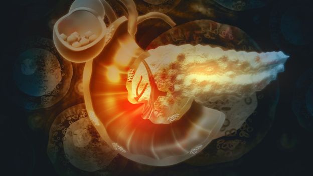 Relacionan los elevados niveles de insulina con el cáncer de páncreas