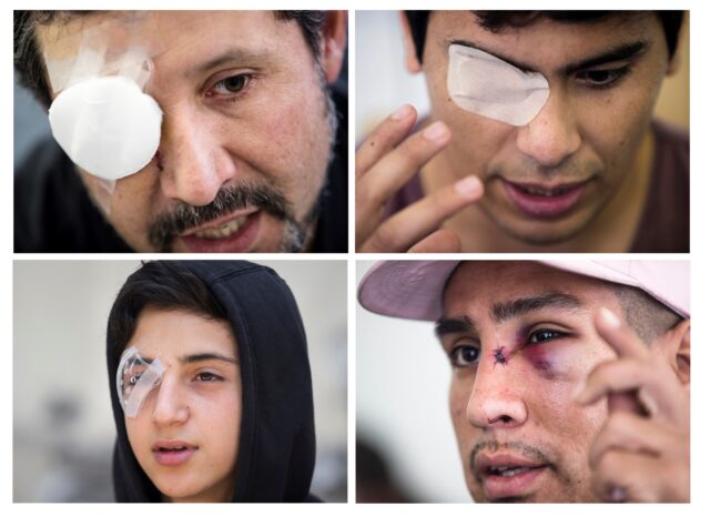 Pérdidas oculares en la represión de manifestantes conmueve en Chile