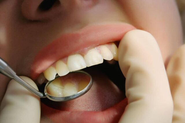 Demuestran que la obesidad está vinculada al padecimiento de periodontitis