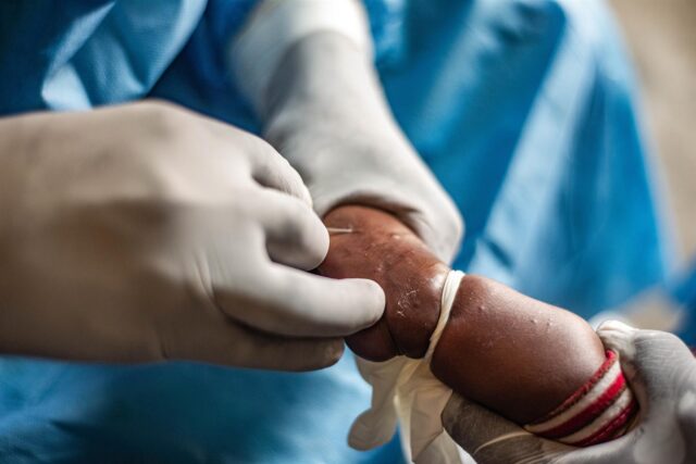 China aprueba la comercialización de su primer test para detectar el virus mpox